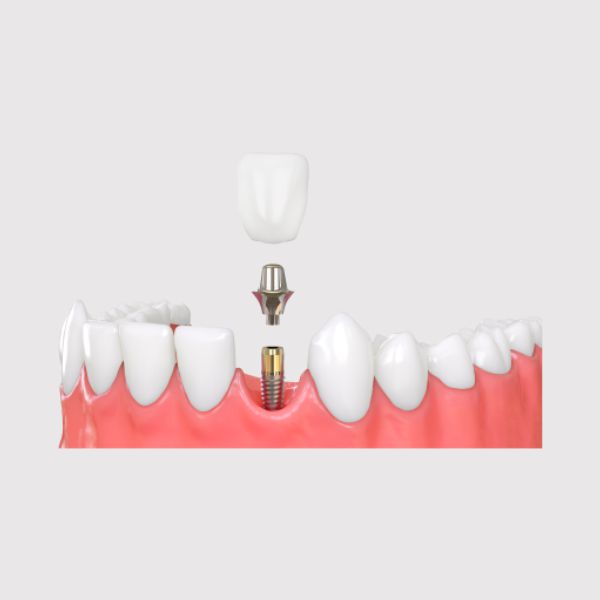 Best dental laboratory in USA I Diverse Dental Lab